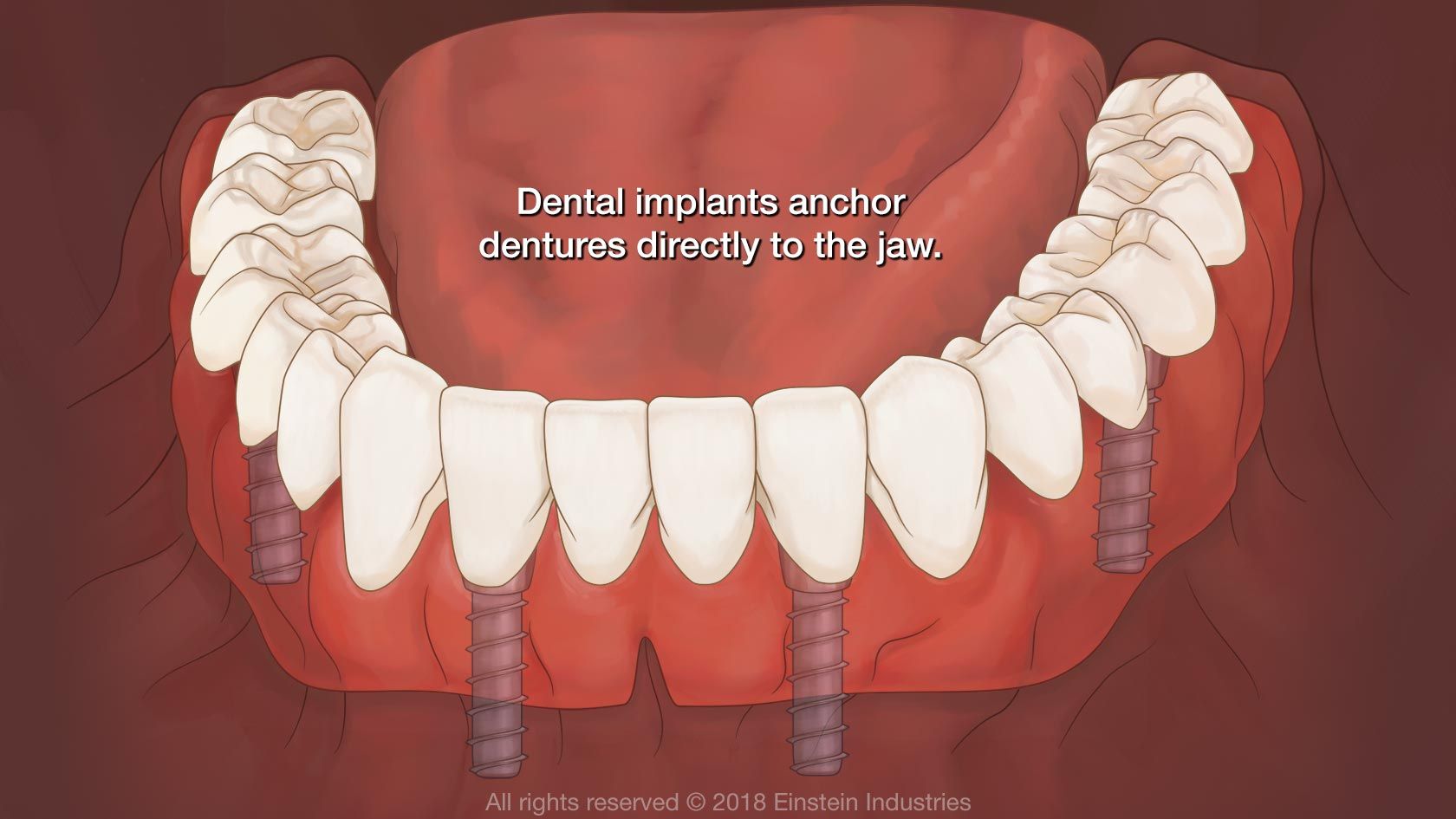 Dental implants anchor denture to the jawbone