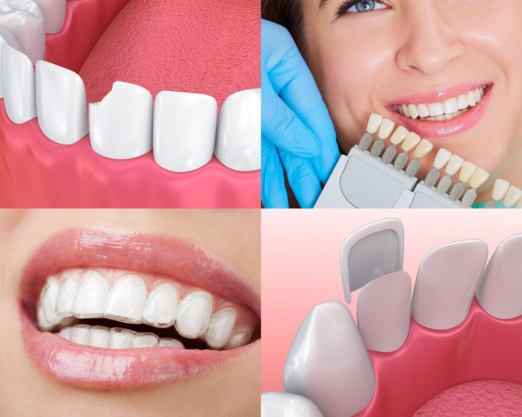chipped tooth, discolored teeth, Invisalign, porcelain veneer